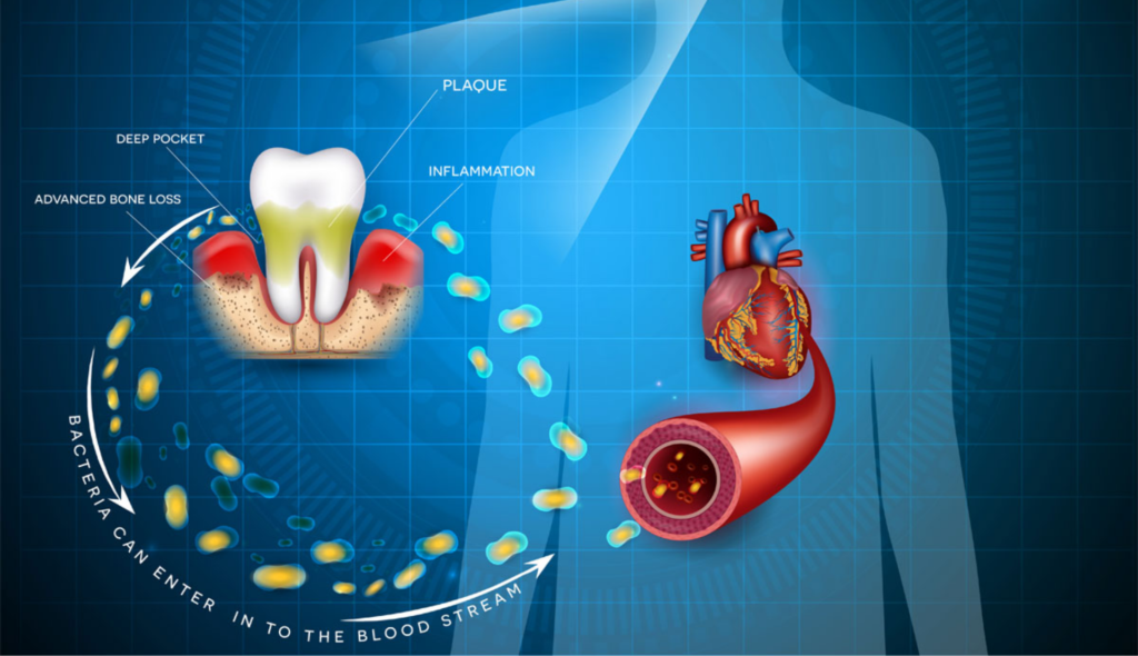 The Connection Between Tooth Decay and Cardiovascular Disease